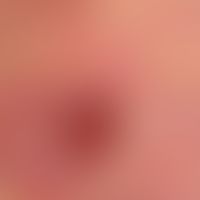 Mycosis fungoides, ulcerated lump on a reddened and scaly area on the back of a 55-year-old man w...