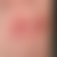 Mycosis fungoides:&nbsp;Detailvergrößerung: Etwa münzgroße, ovaläre Plaques mit atrophischer&nbsp...