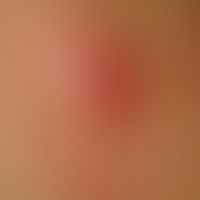 Furunculoid myiasisMyiasis: After a stay in the tropics the 25-year-old patient showed a furuncul...