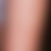 Mycid. hematogenic scattering reaction (Id reaction) in a very extensive tinea corporis treated w...