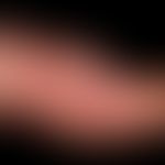 Mycobacterium marinum/Mykobakteriose, nichtuberkulöse:&nbsp;chronische verruköse, unscharf begren...