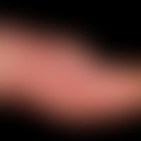 Mycobacterium marinum/Mykobakteriose, nichtuberkulöse:&nbsp;chronische verruköse, unscharf begren...