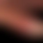 Mycobacterium marinum/Mykobakteriose, nichtuberkulöse:&nbsp;Befund nach 3-&nbsp;monatiger&nbsp;an...
