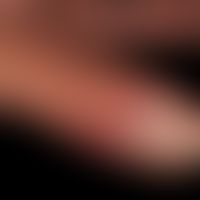 Mycobacterium marinum/Mykobakteriose, nichtuberkulöse:&nbsp;Befund nach 3-&nbsp;monatiger&nbsp;an...