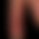 Mycobacterium marinum/Mykobakteriose, nichtuberkulöse:&nbsp;seit 12 Wochen bestehender, unscharf ...