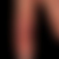 Mycobacterium marinum/Mykobakteriose, nichtuberkulöse:&nbsp;seit 12 Wochen bestehender, unscharf ...