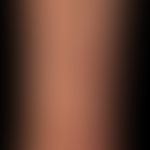 Mycobacterium marinum:&nbsp;untypischer lokalisierter, schmerzloser Knoten. Klinische Bild wenig ...
