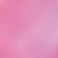 Myxofibroma. detail view: wave-shaped, myxoid loosened connective tissue with embedded myxoid (al...