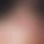 Myxoma, cutaneous. reddish rim of a papule with central crustal coating after evacuation of a muc...