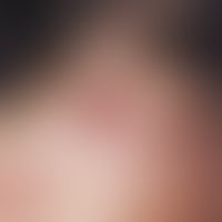 Myxom, kutanes:&nbsp;rötliche, randbetonte Papel mit zentralem Krustenbelag nach Entleerung eines...