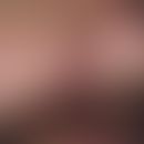 Myxom, kutanes. Hautfarbene Knötchen mit umgebender Rötung am Nasenflügel eines 36-jährigen Patie...