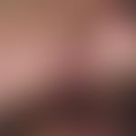 Myxoma, cutaneous skin-colored nodules with surrounding redness at the nostril of a 36-year-old p...