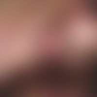 Myxom, kutanes. Hautfarbene Knötchen mit umgebender Rötung am Nasenflügel eines 36-jährigen Patie...