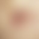 Nabelmetastase. Erbsgroßer, derber, rötlich-livider Knoten mit kleiner, randständiger Kruste in d...