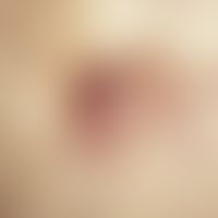 Nabelmetastase. Erbsgroßer, derber, rötlich-livider Knoten mit kleiner, randständiger Kruste in d...