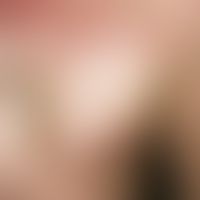 Naevus anaemicus: Approximately palm-sized, irregularly limited, white, smooth stain. No reddenin...