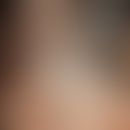 Blauer Naevus. Blauschwarzer, derber, scharf begrenzter, kalottenförmiger Knoten mit glatter Ober...