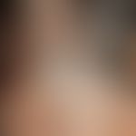 blue naevus. blue-black, coarse, sharply defined, calotte-shaped nodule with a smooth surface. at...