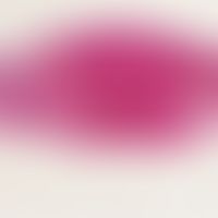 Blue nevus. simple blue nevus; blurredly limited tumor formations which penetrate the entire derm...