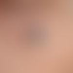 Blue nevus, which has been constant in size for years, measuring approx. 5 x 6 mm, raised, rough ...