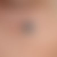 Blue nevus, which has been constant in size for years, measuring approx. 5 x 6 mm, raised, rough ...