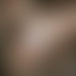 Blue nevus: Solitary, blue-black, sharply defined, indolent, coarse knot with a smooth, shiny sur...