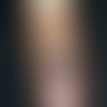 Blue nevus, solitary, 0.7 x 0.4 cm in size, sharply defined, coarse, indolent, blue-black nodule ...