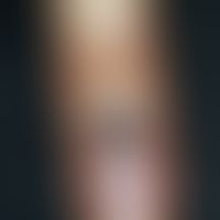 Blue nevus, solitary, 0.7 x 0.4 cm in size, sharply defined, coarse, indolent, blue-black nodule ...