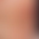 Naevus comedonicus. Streifige Anordnung von Komedonen, Zysten und Narben, im Zentrum Follikulitiden.