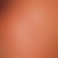 Naevus comedonicus: Strip-like arranged follicular, funnel-like enlarged follicles with yellowish...