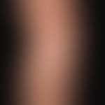 Naevus depigmentosus: congenital harmless localized pigment disorder, no surface progression. cha...