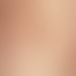 Survey picture: Multiple, densely seeded, whitish-yellowish papules with surrounding redness in t...