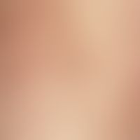 Survey picture: Multiple, densely seeded, whitish-yellowish papules with surrounding redness in t...