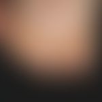 Naevus, epidermaler:&nbsp;(Ausschnitt) epidermaler Naevus am rechten Fuß bei einem 9 Monate alten...