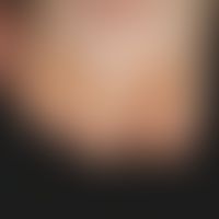 Naevus, epidermaler:&nbsp;(Ausschnitt) epidermaler Naevus am rechten Fuß bei einem 9 Monate alten...