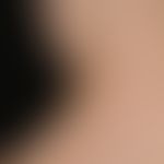 Naevus, epidermaler. Seit Geburt bestehende, erhabene, symptomlose, braune Papeln und Knötchen am...