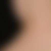Naevus, epidermaler. Seit Geburt bestehende, erhabene, symptomlose, braune Papeln und Knötchen am...