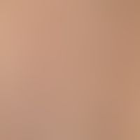 Naevus, epidermaler:&nbsp;seit Geburt bestehende, erhabene, symptomlose, linear angeordnete, in g...