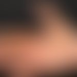 Naevus, epidermaler. Starke Verhornung im Bereich der rechten Hand (Daumen und Index volarseitig,...