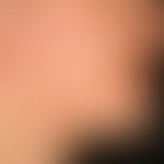 Naevus, epidermaler. Seit dem Kleinkindalter bestehende, leicht hyperkeratotische, leicht hyperpi...