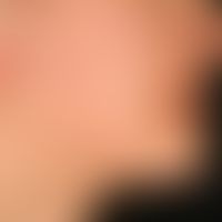 Naevus, epidermaler. Seit dem Kleinkindalter bestehende, leicht hyperkeratotische, leicht hyperpi...