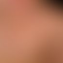 Nevus, epidermal. 0.1-0.3 cm in size, bizarrely configured, brown, partly confluent, symptomless ...