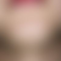 Naevus, epidermaler. Gut abgegrenzte, einem bizarren Linienmuster (Blaschko-Linien) folgende, fla...