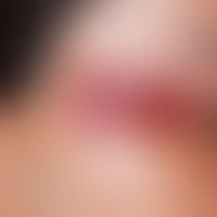 Naevus flammeus (Portwine stain): scharf begrenzter roter Gefäßnaevus der Ober-und Unterlid sowie...