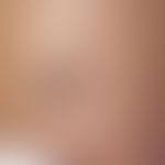 Naevus fuscocoeruleus deltoideoacromialis, coin-sized, slate-gray spot on the shoulder of a 33-ye...