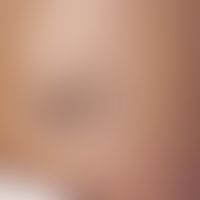 Naevus fuscocoeruleus deltoideoacromialis, coin-sized, slate-gray spot on the shoulder of a 33-ye...