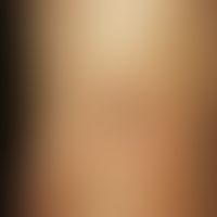 nevus lipomatodes cutaneus superficialis. solitary, sponge-like soft, to the side well delimitabl...