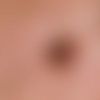 Common melanocytic nevus. sharply defined, acquired, homogeneously pigmented melanocytic nevus. s...