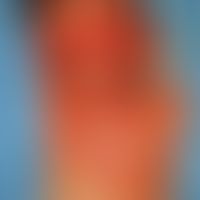 Naevus, melanozytärer, Naevus giganteus. Unmittelbar postoperativ. Das abradierte Areal ist pigme...