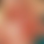 Naevus, melanozytärer, Naevus giganteus. Weitgehende Epithelisierung am 10. Tag postoperativ.